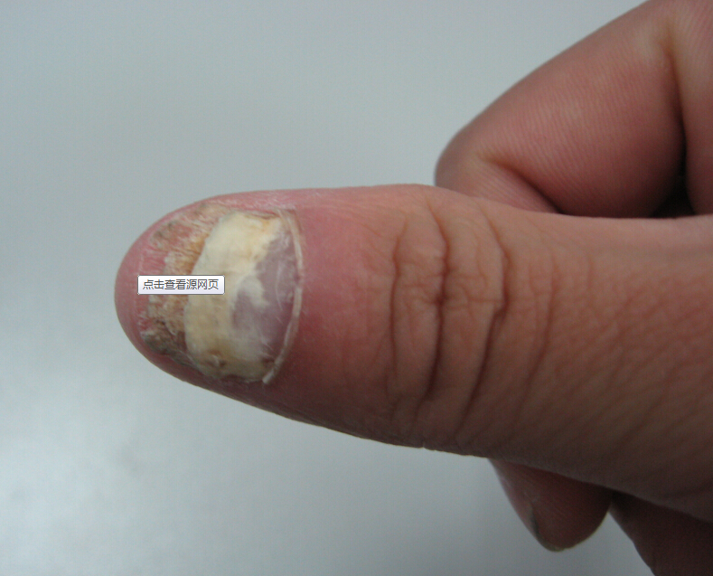 治疗慢性甲沟炎型灰指甲