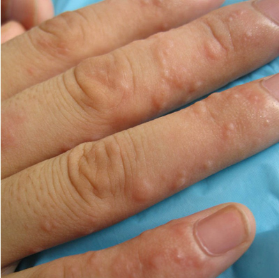 手指湿疹最佳治疗方法