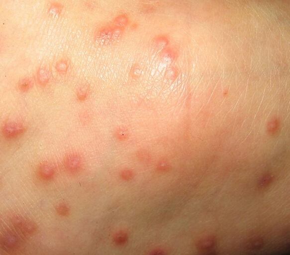 起湿疹是什么原因