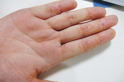 治疗手部湿疹的方法
