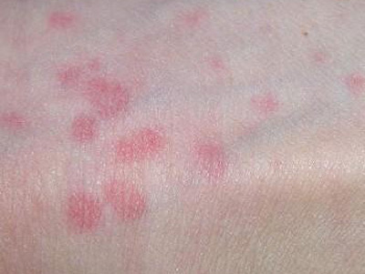 皮肤科 湿疹 症状 瘙痒性:其特点是持续性瘙痒,依靠分散注意力