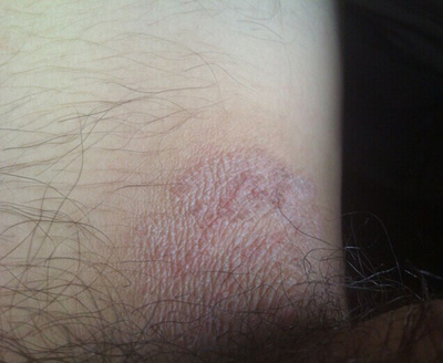 阴囊湿疹初期症状