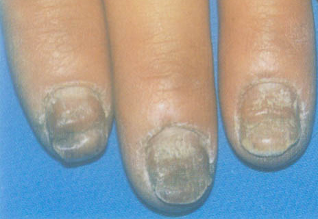 如果灰指甲不治疗会怎么样