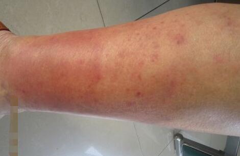 紫红色斑疹会传染吗