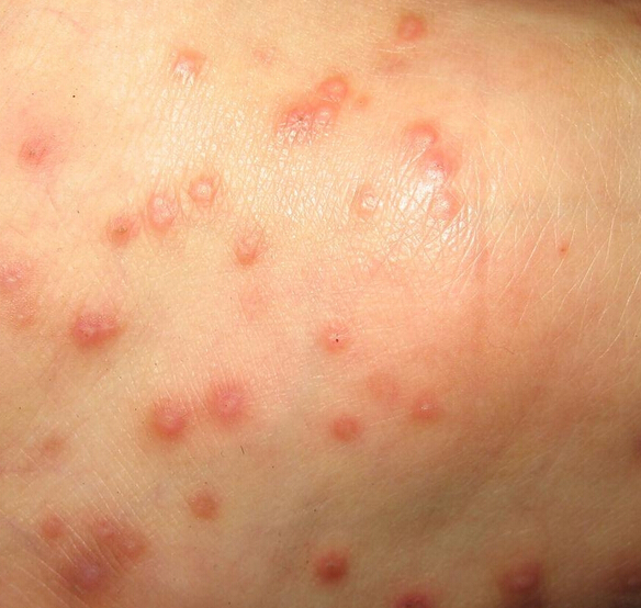 皮肤湿疹用什么药