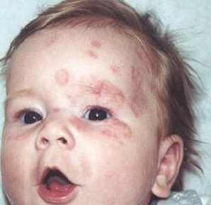 婴儿红斑狼疮早期症状
