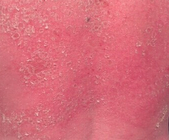 红皮病型银屑病中药怎样治疗