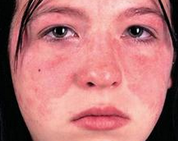 红斑狼疮早期症状脸痒正常吗