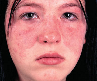 红斑狼疮脸部早期症状