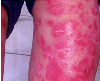 青年红皮病型银屑病预防应注意什么_飞华健康网