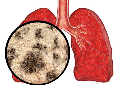 阻塞性肺气肿该如何预防