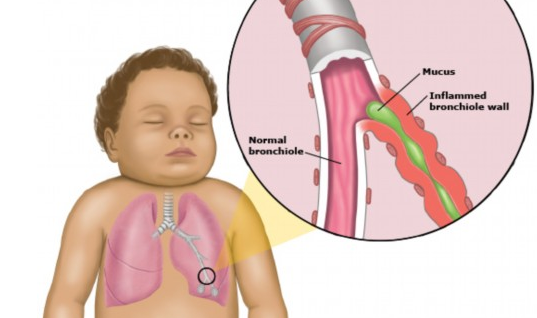 小儿肺气肿的典型症状