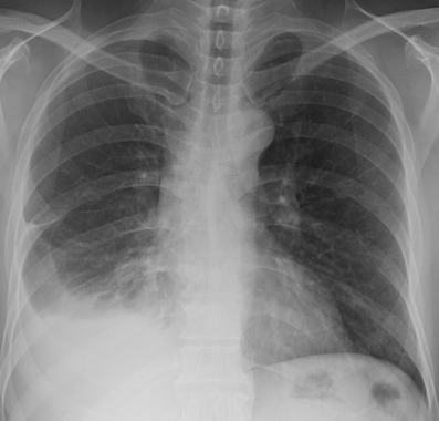 肺气肿的影像表现有哪些