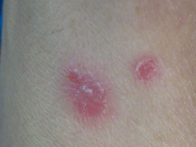 牛皮癣初期红疹表现为什么症状