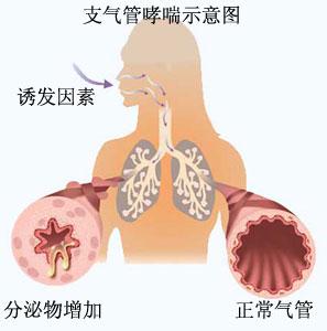 支气管哮喘原因有哪些
