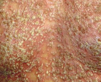 脓疱型牛皮癣是种危害性极大的皮肤病,大家治疗前,一定要查明病因