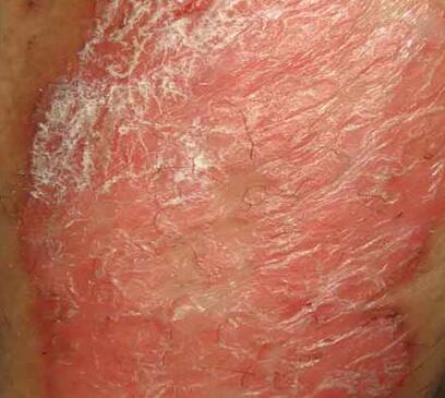 红皮病牛皮癣的治疗注意事项有哪些_飞华健康网