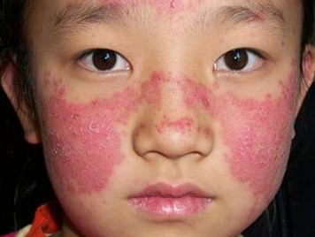 面部红斑狼疮的症状有哪些