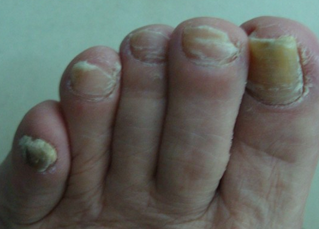 脚灰指甲治疗办法有哪些