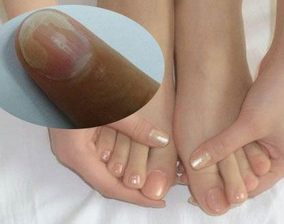 灰指甲的治疗办法有哪些呢