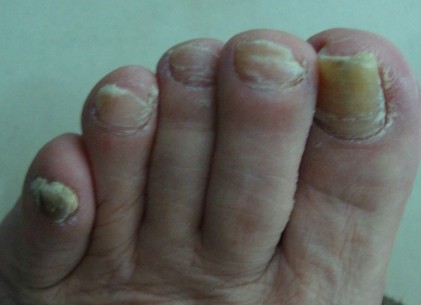 脚上灰指甲的治疗方法是什么