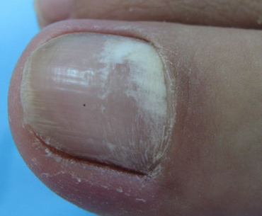 真菌性灰指甲怎么治疗