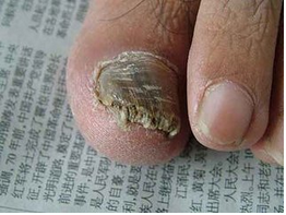 脚上灰指甲原因有哪些