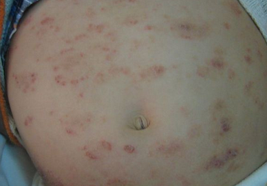 过敏性湿疹治疗方法有哪些