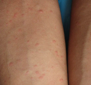 荨麻疹和水痘的区别是什么