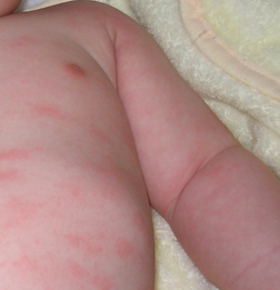宝宝荨麻疹发作怎么办