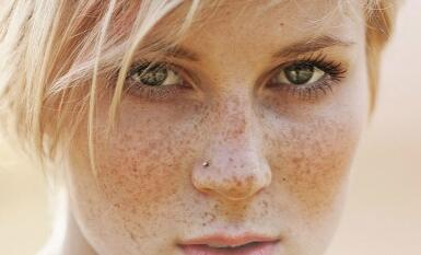 长黄褐斑是否存在遗传性