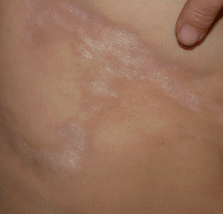 > 皮肤科 > 硬皮病 > 症状    1,水肿期:表现为皮肤变厚,绷紧,皱纹