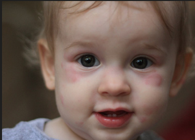 小儿荨麻疹治疗方法