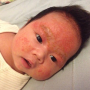 初生婴儿湿疹怎么办