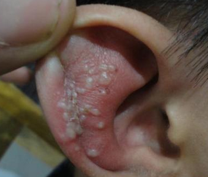 外耳道湿疹的症状