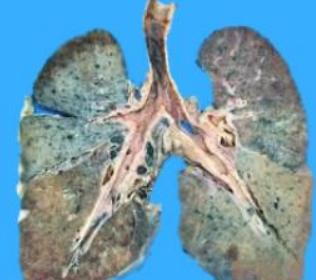 肺纤维化难以治疗,患上这种疾病之后,有可能是会伴随患者的一生