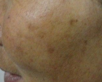 肝斑和黄褐斑区别