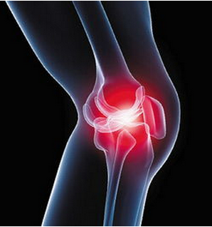 膝关节炎典型症状有哪些