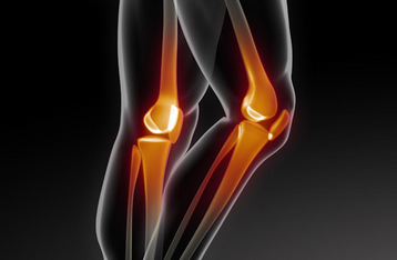1,膝关节炎导致膝关节疼痛