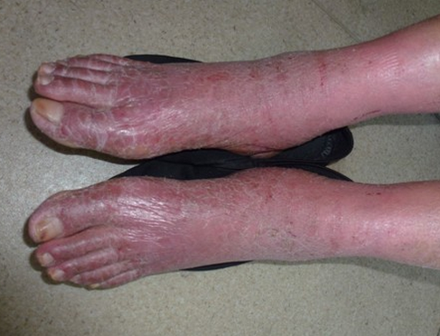 脚部湿疹初期症状