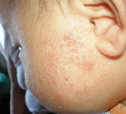 知识库 正文  婴儿湿疹是小儿最常见的皮肤病.
