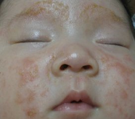 幼儿湿疹的图片和症状