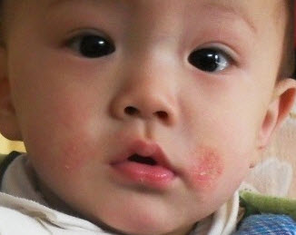 婴儿湿疹是怎么引起的