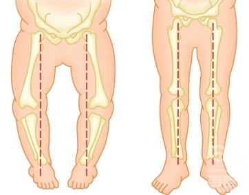 患o型腿的危害大吗