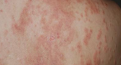 季节性湿疹怎么护理