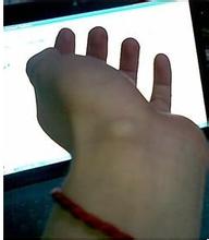 受凉之后腱鞘炎会发作吗