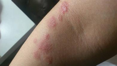 荨麻疹跟湿疹的区别有哪些?