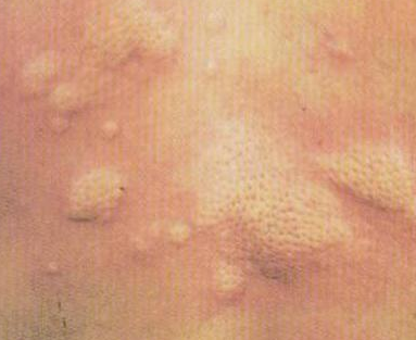 好发于婴儿及儿童,皮损常为圆形或梭形之风疹块样损害,顶端可有针头到