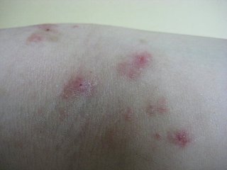 荨麻疹与湿疹区别有哪些