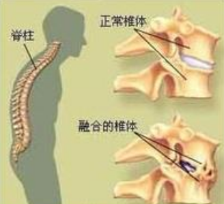 早期强直性脊柱炎预防方法